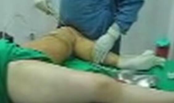 大腿抽脂整形手术过程