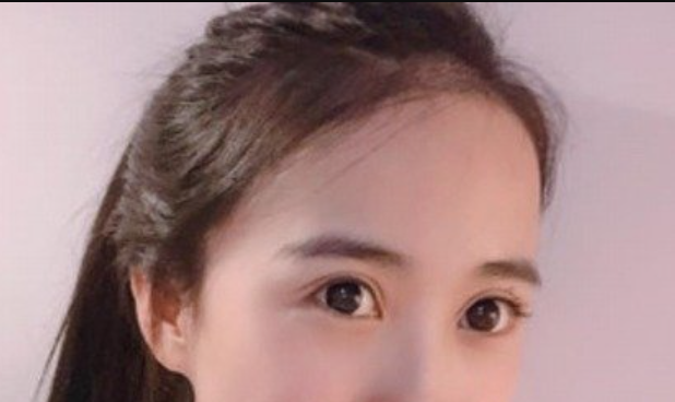 双眼皮手术做什么好