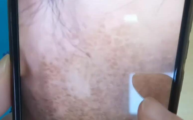 女子为护肤1个月不洗脸致满脸结痂