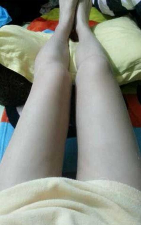 激光溶脂瘦大腿后